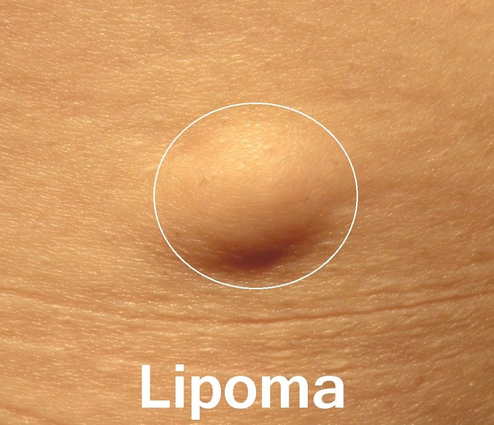 Symptoms lipoma Is it